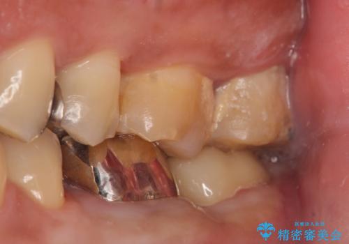 歯冠長延長術を併用した審美的歯科治療の治療後