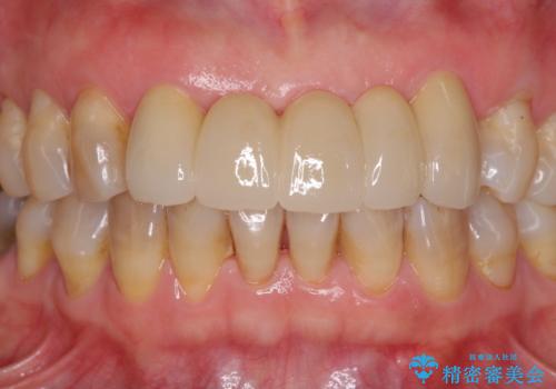 古くなった前歯のブリッジをオールセラミックにの治療後