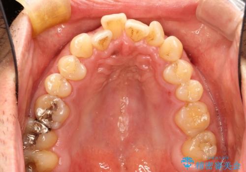 インビザライン invisalign ガタつきを治すマウスピース矯正の治療前