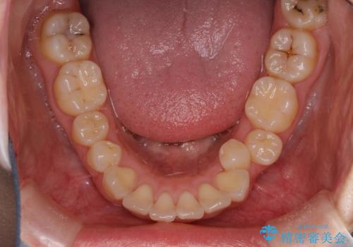 抜歯をして前歯を下げ、ガタつきを取り除く　ワイヤー矯正の治療前