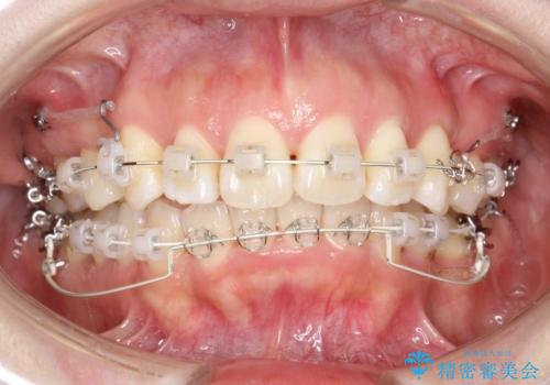 抜歯をして前歯を下げ、ガタつきを取り除く　ワイヤー矯正の治療中