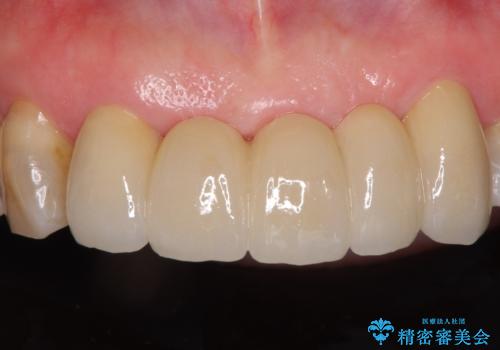 古くなった前歯のブリッジをオールセラミックにの治療後