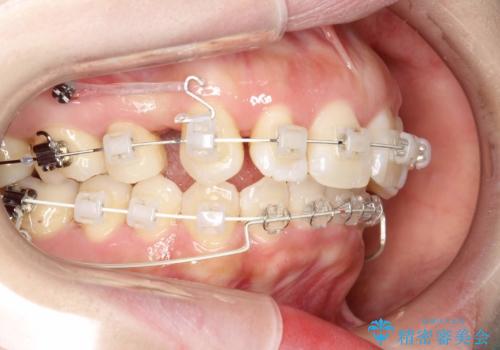 抜歯をして前歯を下げ、ガタつきを取り除く ワイヤー矯正の治療中