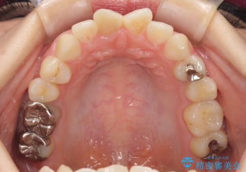 変色した歯をセラミックにしたい 歯自体が変色している場合の参考用2の治療前