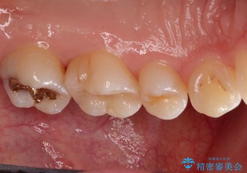 一度治療した歯が虫歯に セラミックインレーで治療の治療後