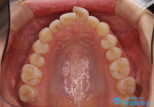 口が閉じにくい 1本飛び出した前歯の矯正治療の治療前