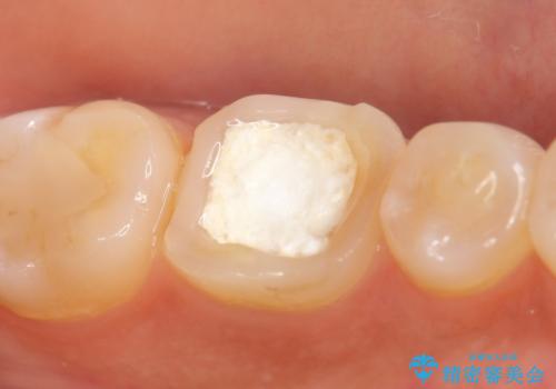 オールセラミッククラウン 根管治療後の補綴の治療前