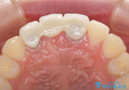 歯肉から血が 前歯のオールセラミックブリッジの再製作の治療前