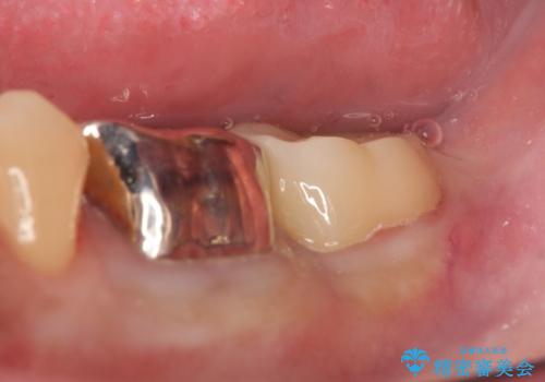 歯冠長延長術を併用した審美的歯科治療の治療後