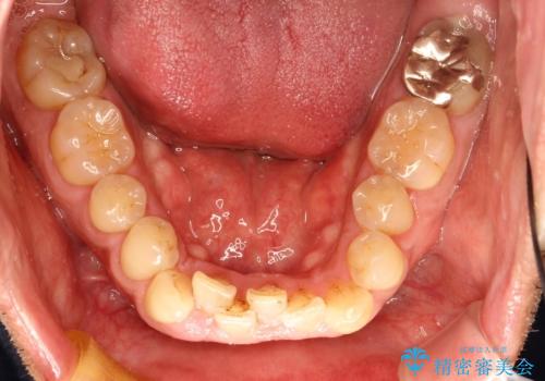 インビザライン invisalign ガタつきを治すマウスピース矯正の治療前