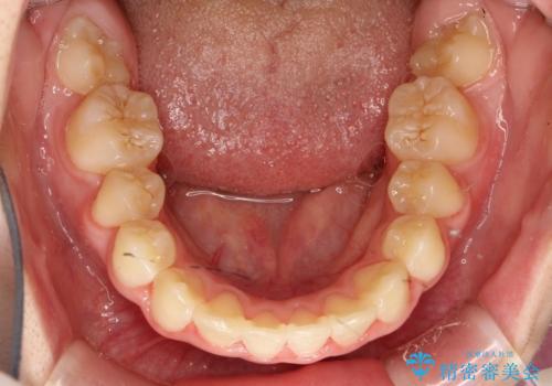 永久歯が生えてこない　ワイヤー矯正で複雑な状態を正常咬合へ誘導するの治療後