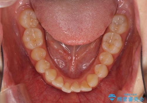 口が閉じにくい 1本飛び出した前歯の矯正治療の治療前