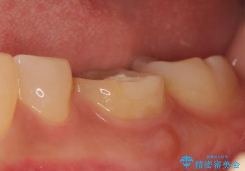 オールセラミッククラウン 根管治療後の補綴の治療前