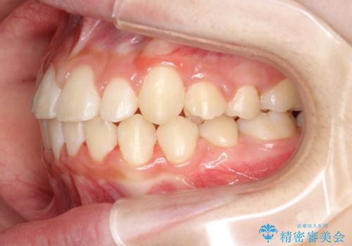 永久歯が生えてこない　ワイヤー矯正で複雑な状態を正常咬合へ誘導するの症例 治療後