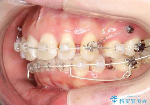 抜歯をして前歯を下げ、ガタつきを取り除く ワイヤー矯正の治療中