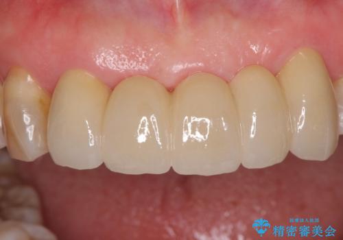 古くなった前歯のブリッジをオールセラミックにの治療後