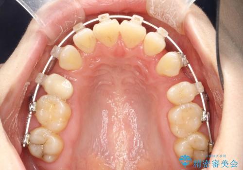抜歯をして前歯を下げ、ガタつきを取り除く　ワイヤー矯正の治療中