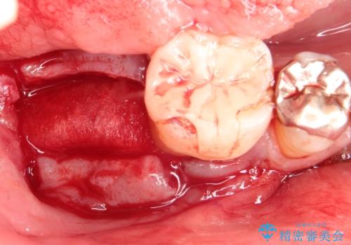 奥歯が痛い。骨増生を併用したインプラントの治療前