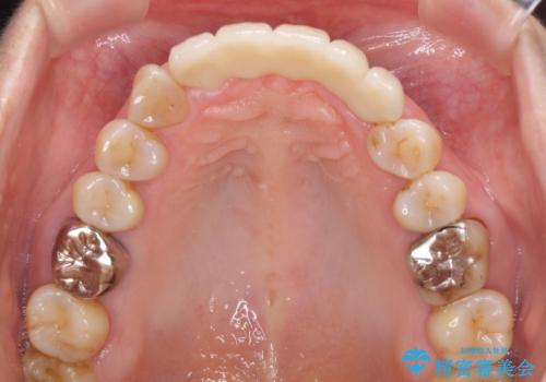 古くなった前歯のブリッジをオールセラミックにの治療後