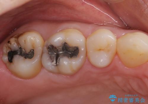 むし歯の治療。ゴールドインレーによる修復の症例 治療前