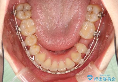 抜歯をして前歯を下げ、ガタつきを取り除く ワイヤー矯正の治療中