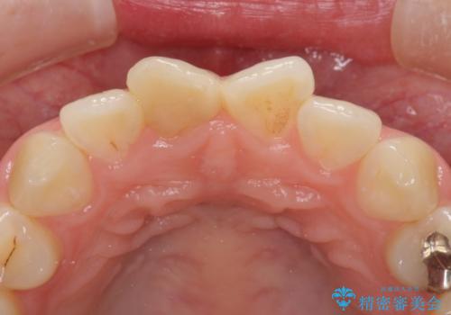 変色した歯をセラミックにしたい　歯自体が変色している場合の参考用2の治療前