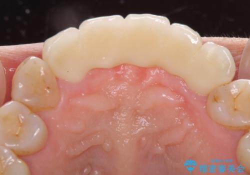 古くなった前歯のブリッジをオールセラミックにの治療後