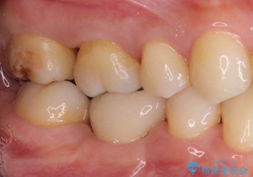 むし歯の治療。ゴールドインレーによる修復の治療前