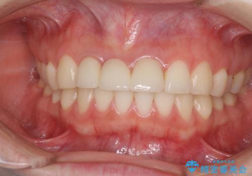 歯肉から血が 前歯のオールセラミックブリッジの再製作の治療後