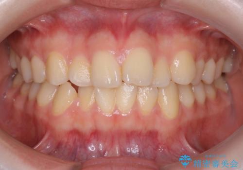 インビザラインによるガタつきの矯正治療 シンプル・短期間の治療前