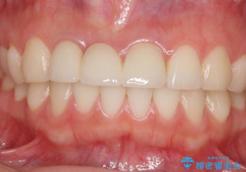歯肉から血が　前歯のオールセラミックブリッジの再製作の治療後