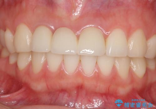 歯肉から血が 前歯のオールセラミックブリッジの再製作の治療後