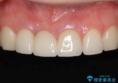歯肉から血が　前歯のオールセラミックブリッジの再製作の症例 治療後
