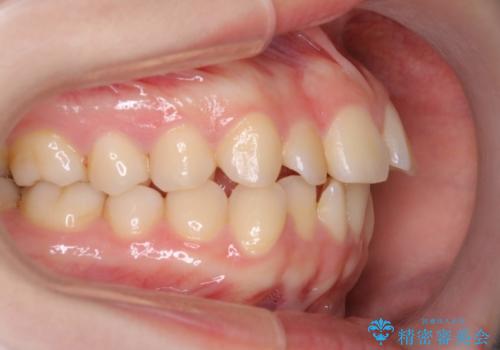 インビザラインによるガタつきの矯正治療 シンプル・短期間の治療前