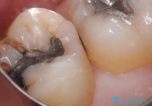 むし歯の治療。ゴールドインレーによる修復の治療中