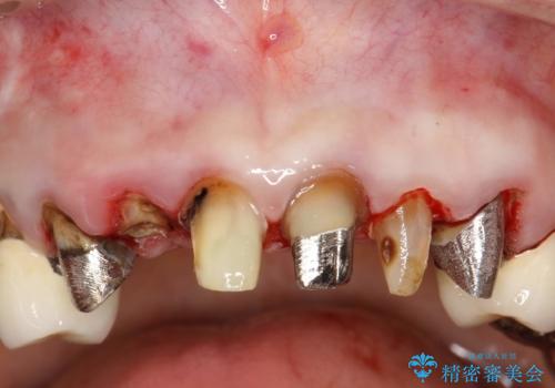 前歯の低クオリティな治療の実態　妥協無い治療で根本からやり治すの治療前