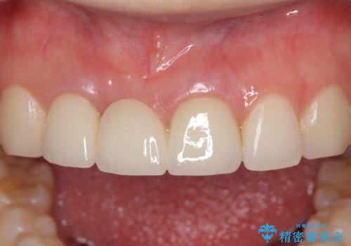 歯肉から血が 前歯のオールセラミックブリッジの再製作の治療後