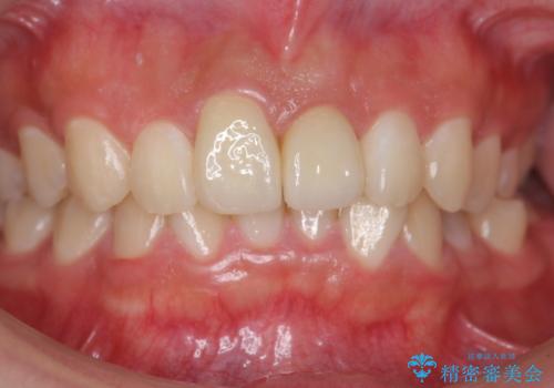 出っ歯をセラミックで治したい の症例 治療後