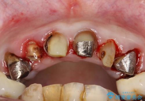 前歯の低クオリティな治療の実態 妥協無い治療で根本からやり治すの治療前