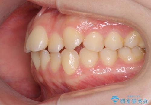 インビザラインによるガタつきの矯正治療 シンプル・短期間の治療前