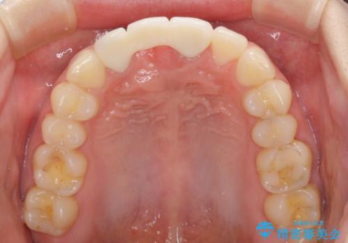 歯肉から血が 前歯のオールセラミックブリッジの再製作の治療後