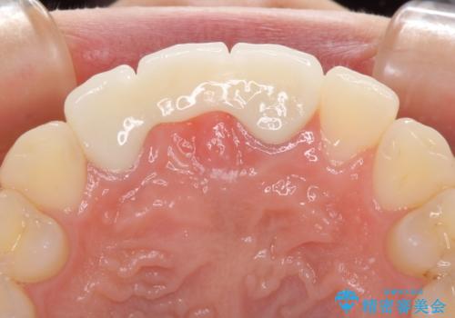 歯肉から血が 前歯のオールセラミックブリッジの再製作の治療後