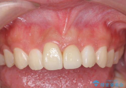 出っ歯をセラミックで治したい の治療後
