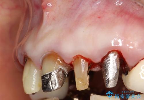 前歯の低クオリティな治療の実態 妥協無い治療で根本からやり治すの治療前