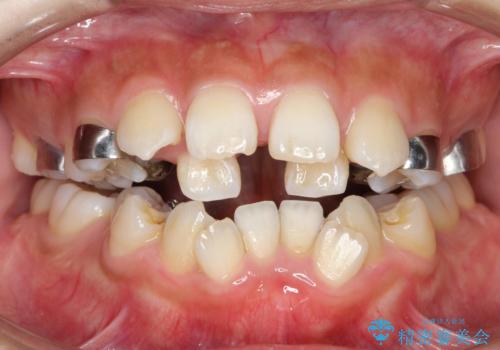 人生が変わる 困難を極める咬合状態に歯列矯正単独で挑戦するの治療中