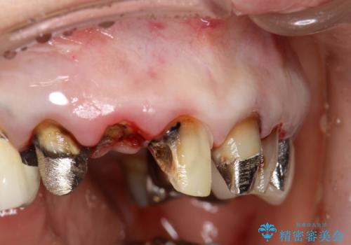 前歯の低クオリティな治療の実態 妥協無い治療で根本からやり治すの治療前