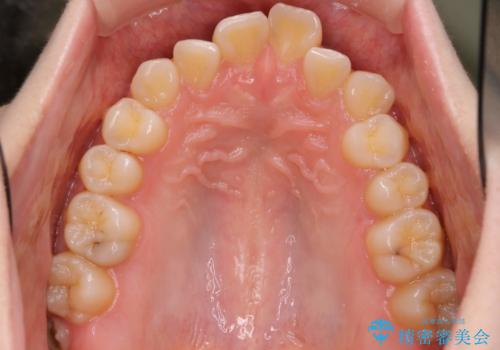 インビザラインによるガタつきの矯正治療 シンプル・短期間の治療前