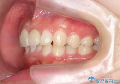 出っ歯をセラミックで治したい の治療後