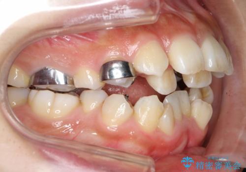 人生が変わる 困難を極める咬合状態に歯列矯正単独で挑戦するの治療中