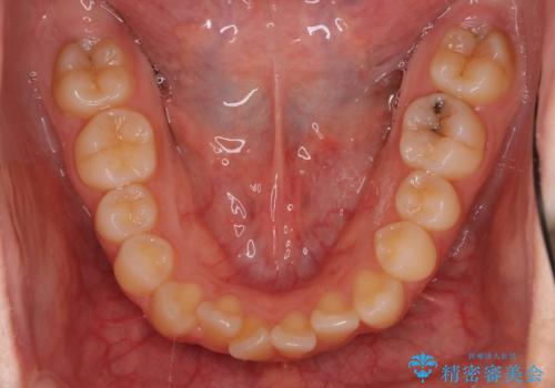 インビザラインによるガタつきの矯正治療 シンプル・短期間の治療前